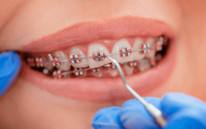 Избранные вопросы ортодонтического лечения больных с заболеваниями зубо-челюстно-лицевой области